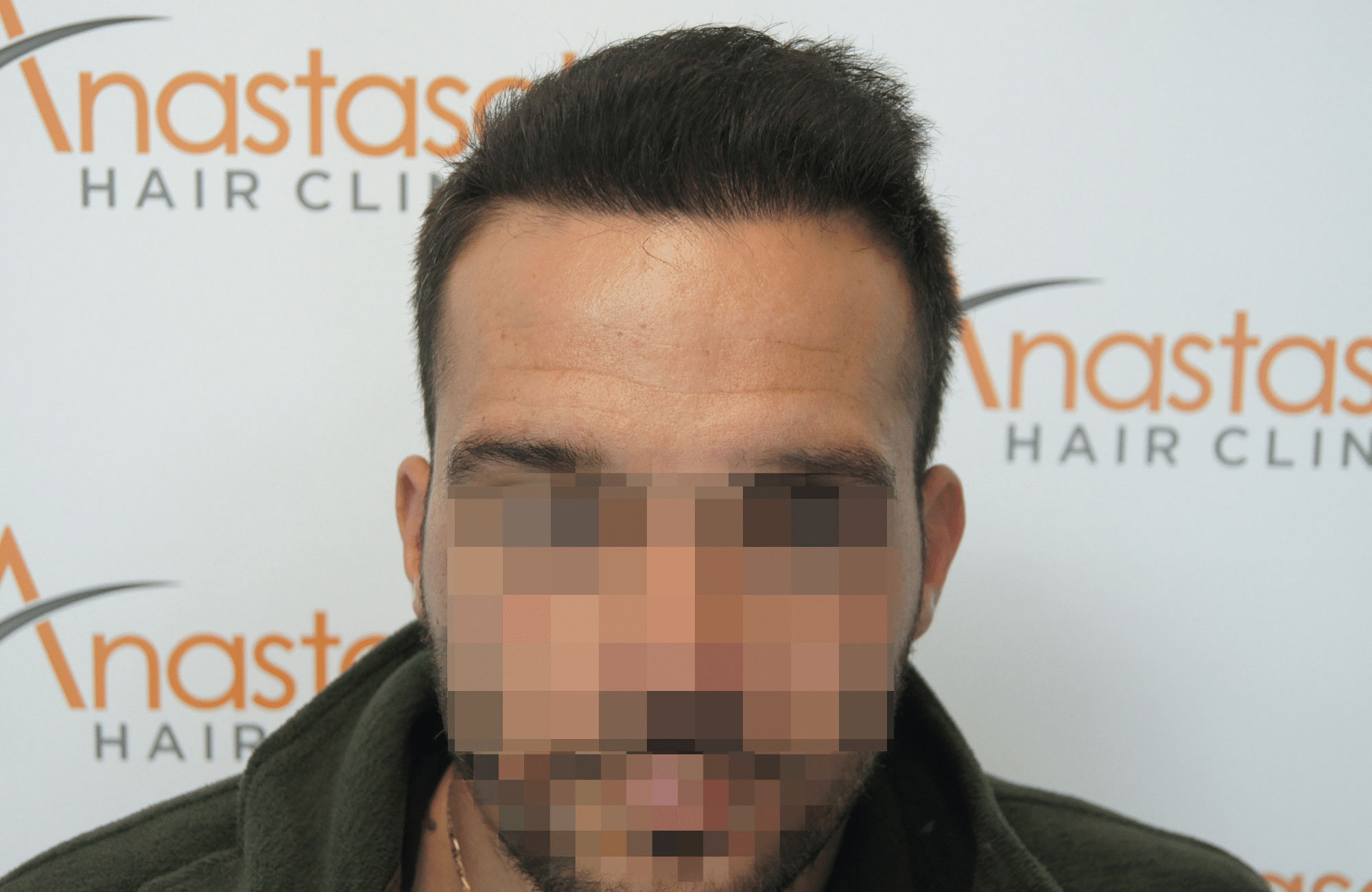 φυσικό αποτελεσμα πυκνωσης στη μεταμόσχευση μαλλιων στην anastasakis hair clinic ΜΕ 2500 ΤΡΙΧΟΘΥΛΑΚΙΑ anastasakis hair clinic