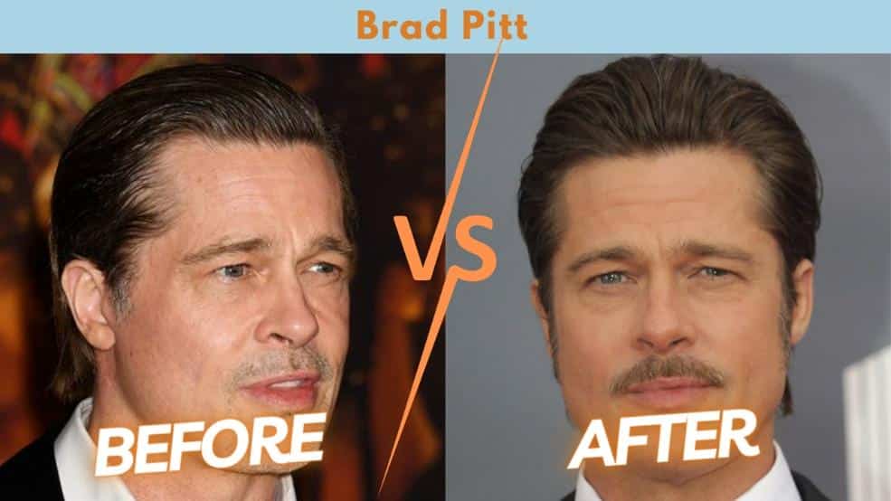Μεταμόσχευση Μαλλιών σε Celebrities - Brad Pitt