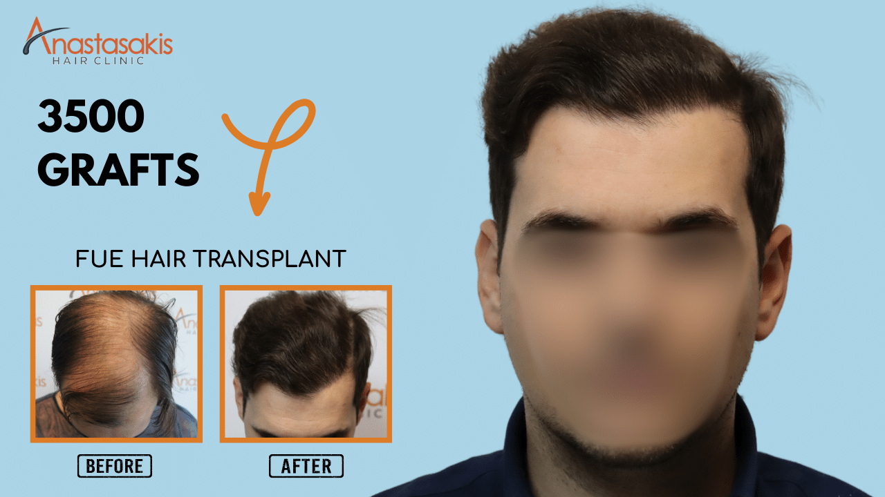 Anastasakis Hair Clinic
