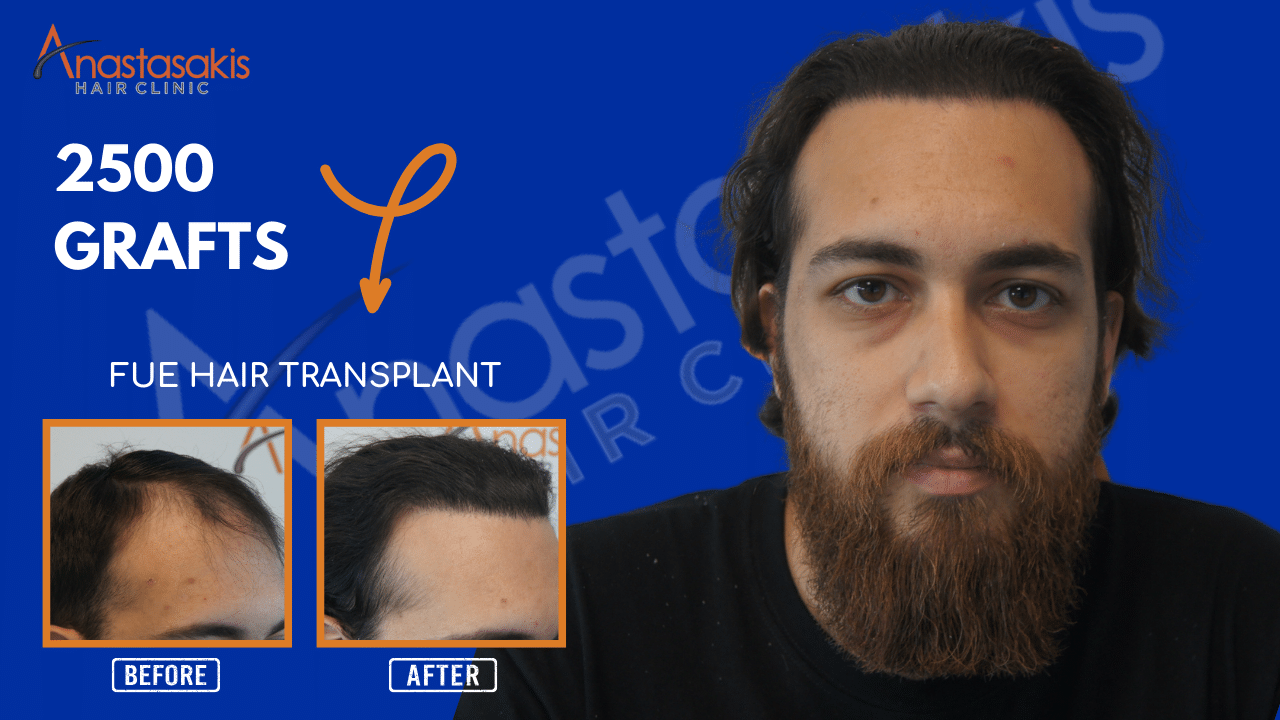 απολυτα φυσικό αποτελεσμα στη μεταμόσχευση μαλλιων στην anastasakis hair clinic ΜΕ 2500 ΤΡΙΧΟΘΥΛΑΚΙΑ βιντεο